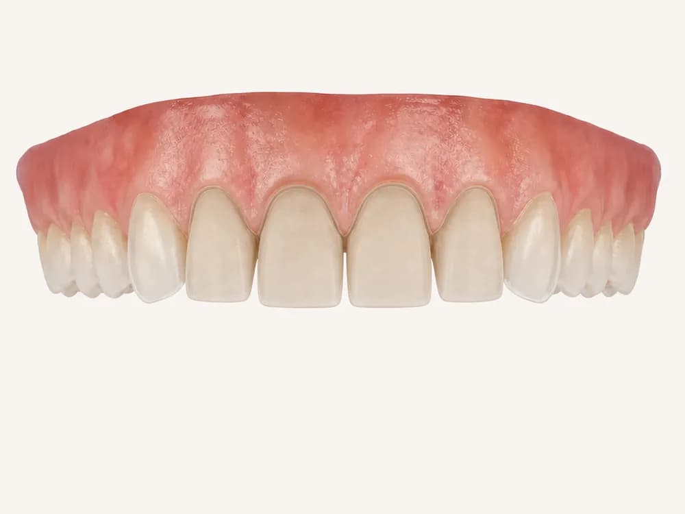 Derselbe Bogen, bei dem die Frontzähne leicht für Veneers vorbereitet sind