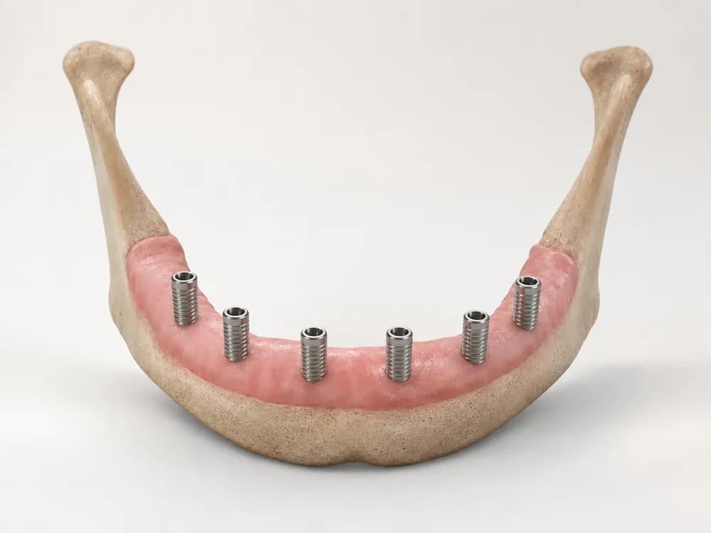 Derselbe Kiefer mit sechs gleichmäßig über den Bogen verteilten, aufrecht gesetzten Implantaten
