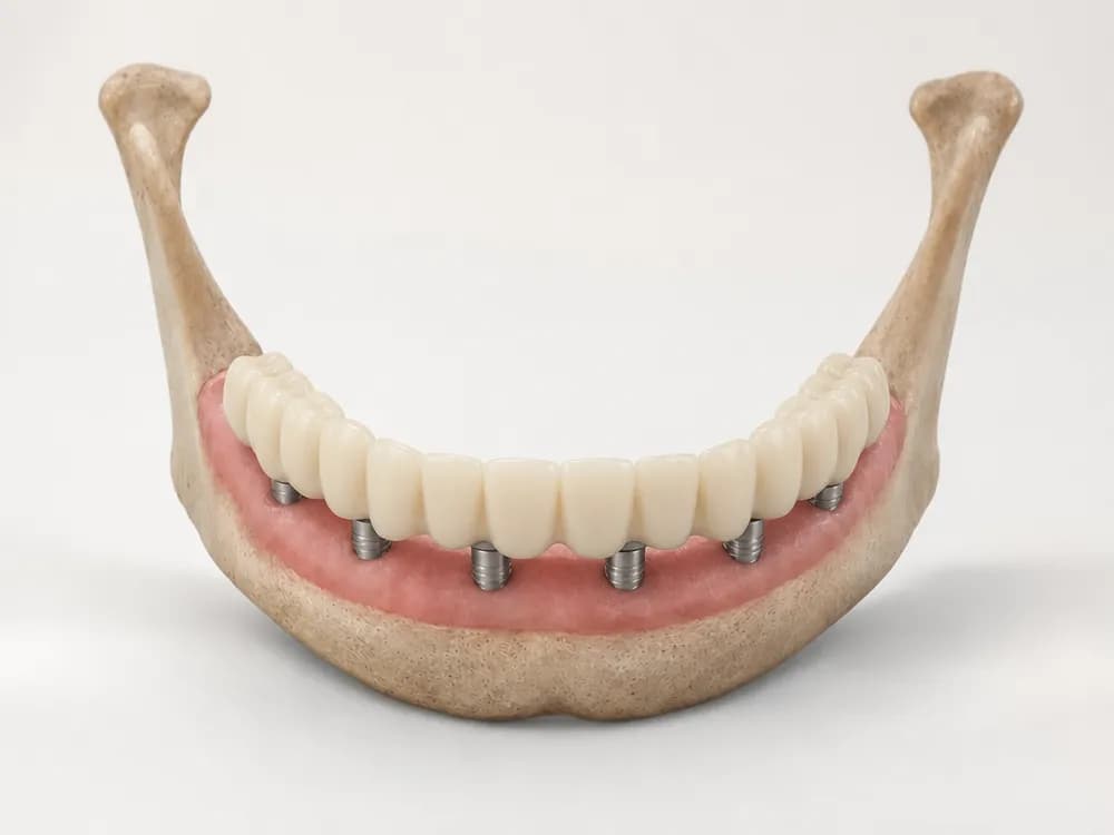 Eine fest verschraubte provisorische Brücke über dem ganzen Kiefer, auf den sechs Implantaten sitzend