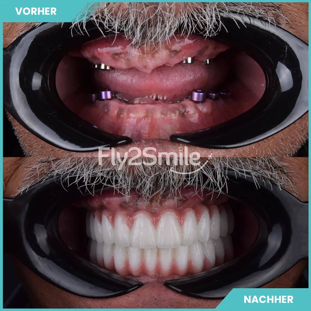Veneers & Zahnimplantate – Zähne machen lassen in der Türkei mit Fly2Smile — Foto aus dem Google-Eintrag der Praxis