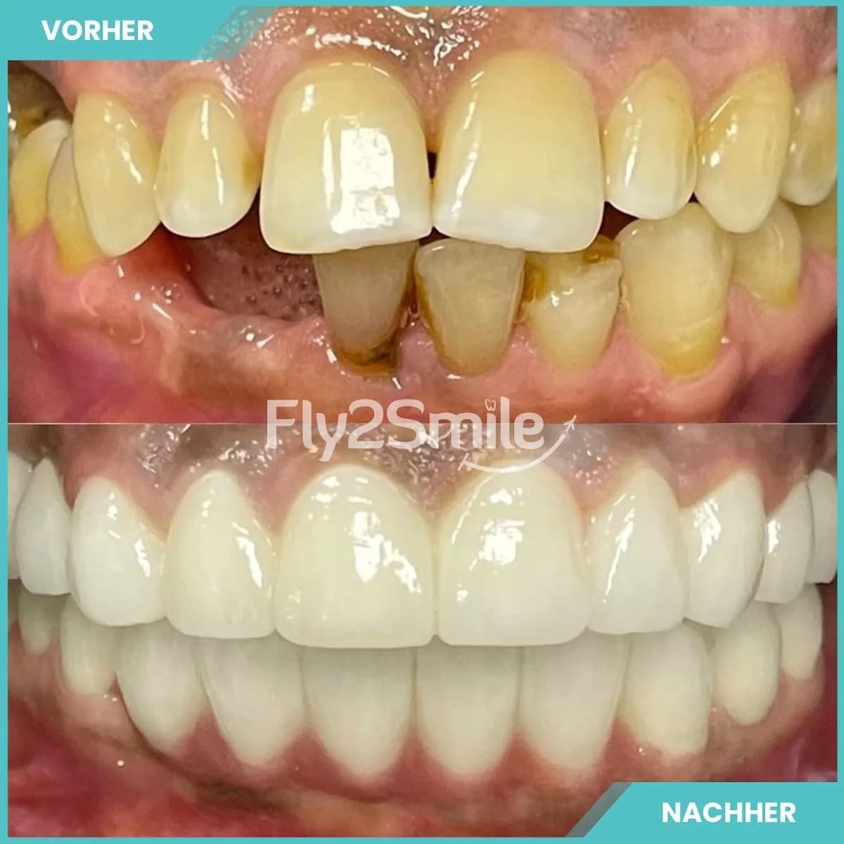 Veneers & Zahnimplantate – Zähne machen lassen in der Türkei mit Fly2Smile — Foto aus dem Google-Eintrag der Praxis