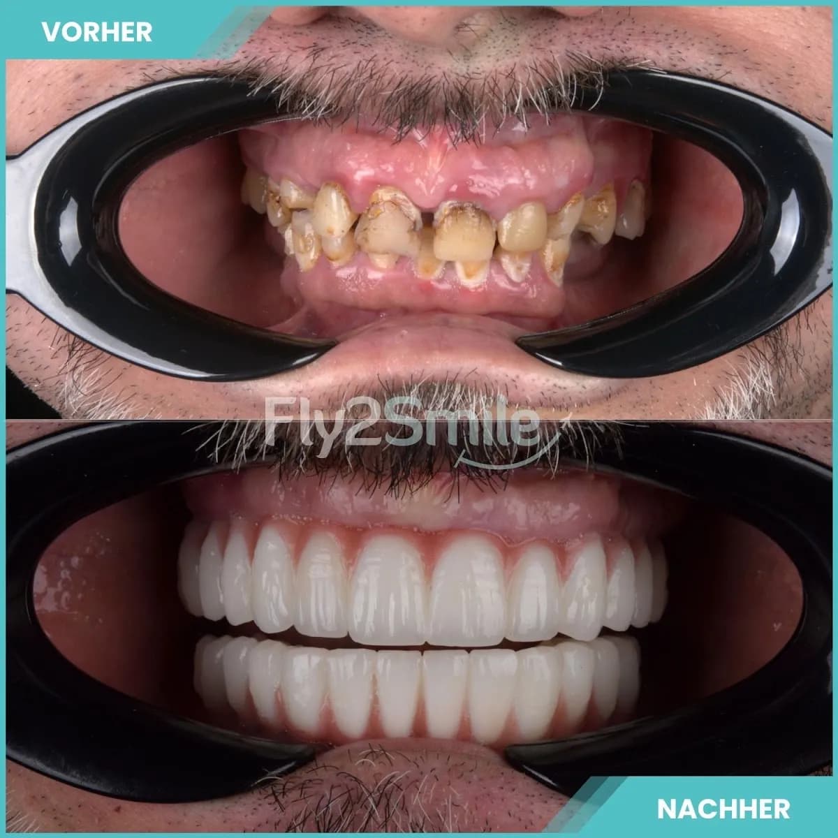 Veneers & Zahnimplantate – Zähne machen lassen in der Türkei mit Fly2Smile — Foto aus dem Google-Eintrag der Praxis